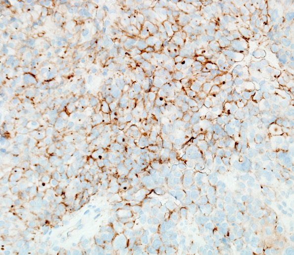 5E2 Astroblastoma, anaplastic (Case 5) D2-40 1.jpg