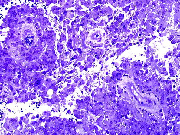 5F1 Astroblastoma (Case 5) Plastic 2.jpg