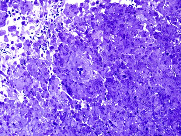 5F2 Astroblastoma (Case 5) Plastic 3.jpg