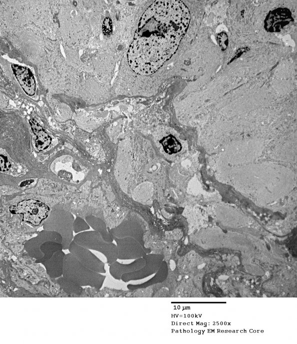 5G1 Astroblastoma (Case 5) EM 63 - Copy