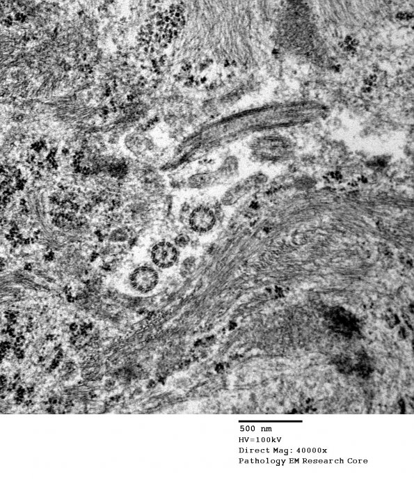 5G10 Astroblastoma (Case 5) EM 41 - Copy - Copy