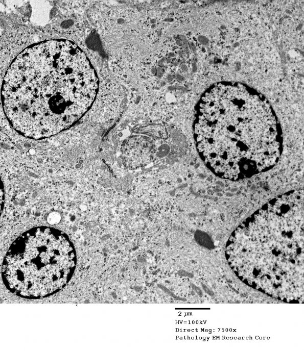 5G11 Astroblastoma (S15-42747) EM 45 - Copy