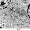 5G12 Astroblastoma (Case 5) EM 47 - Copy