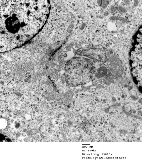 5G12 Astroblastoma (Case 5) EM 47 - Copy