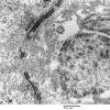 5G13 Astroblastoma (Case 5) EM 49 - Copy - Copy (2)