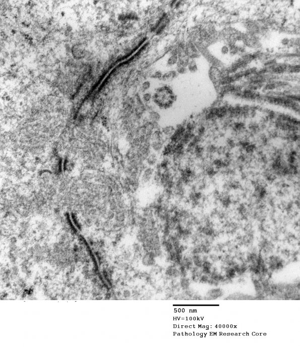 5G13 Astroblastoma (Case 5) EM 49 - Copy - Copy (2)