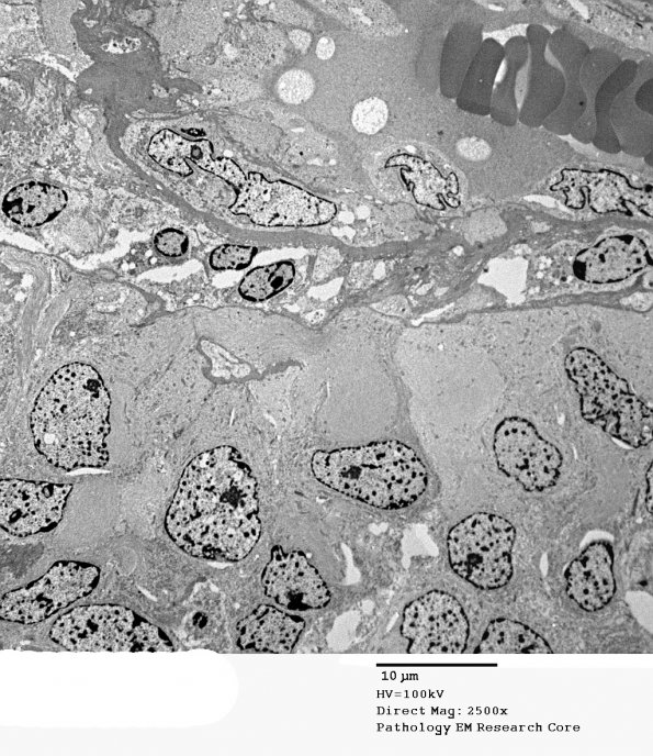 5G2 Astroblastoma (Case 5) EM 54 - Copy - Copy