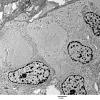 5G3 Astroblastoma (Case 5) EM 73 - Copy