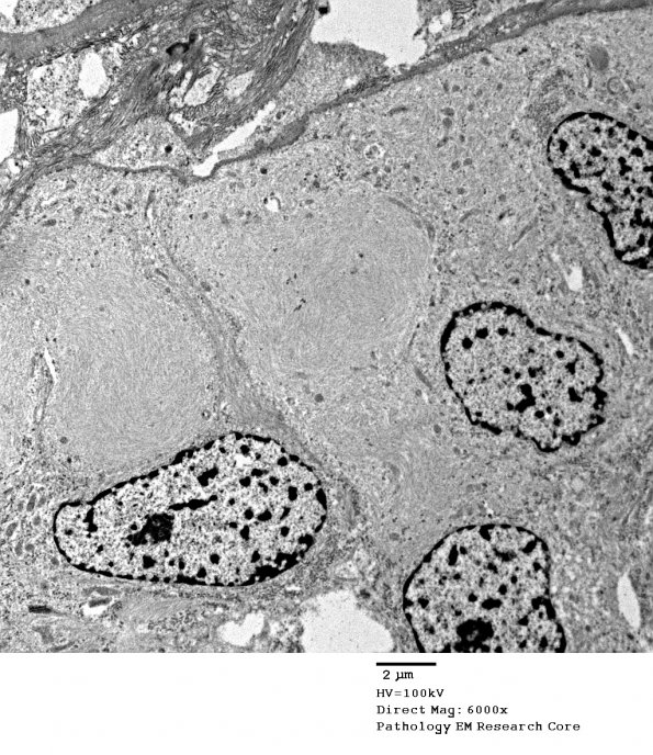 5G3 Astroblastoma (Case 5) EM 73 - Copy