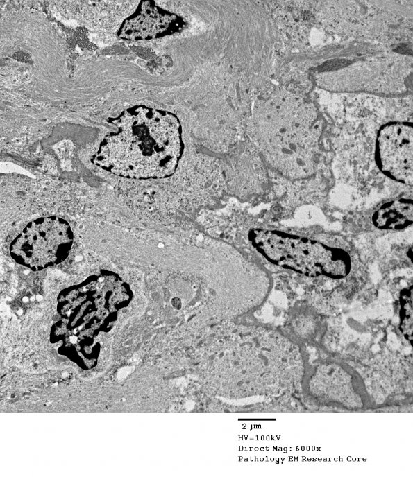 5G4 Astroblastoma (Case 5) EM 72 - Copy