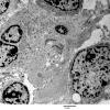 5G5 Astroblastoma (Case 5) EM 24 - Copy