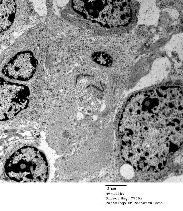 5G5 Astroblastoma (Case 5) EM 24 - Copy