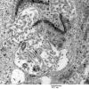 5G6 Astroblastoma (Case 5) EM 25 - Copy