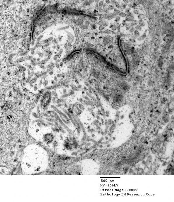 5G6 Astroblastoma (Case 5) EM 25 - Copy