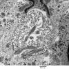 5G7 Astroblastoma (Case 5) EM 32 - Copy - Copy