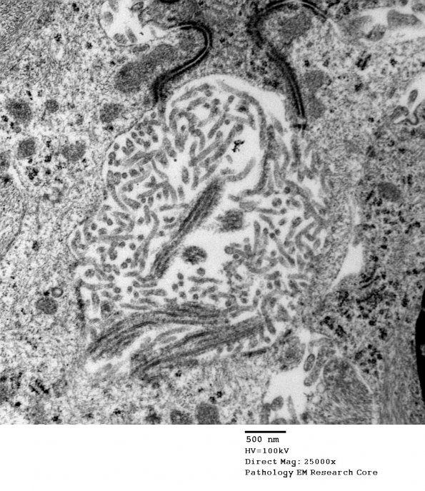 5G7 Astroblastoma (Case 5) EM 32 - Copy - Copy