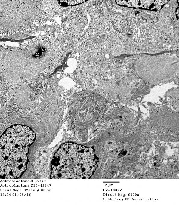 5G8 Astroblastoma (Case 5) EM 39 - Copy