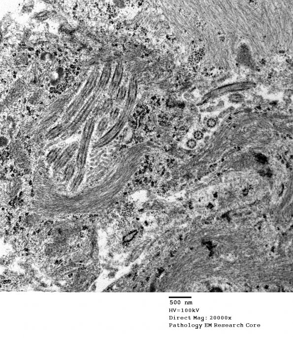 5G9 Astroblastoma (Case 5) EM 40 - Copy