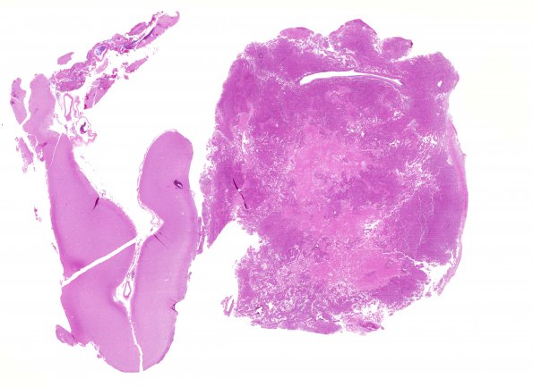 6A1 Astroblastoma, malig (Case 6) H&E WM