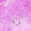 6A2 Astroblastoma, malig (Case 6) H&E 8