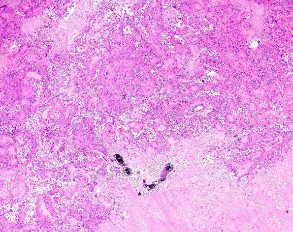 6A2 Astroblastoma, malig (Case 6) H&E 8