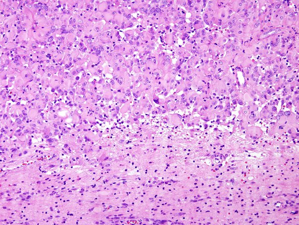 6A4 Astroblastoma, malig (Case 6) H&E 2 (edge)