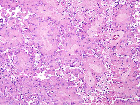 6A5 Astroblastoma, malig (Case 6) H&E 3