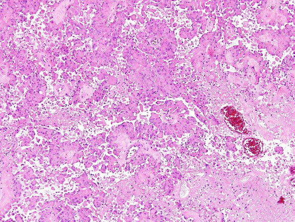 6A6 Astroblastoma, malig (Case 6) H&E 7