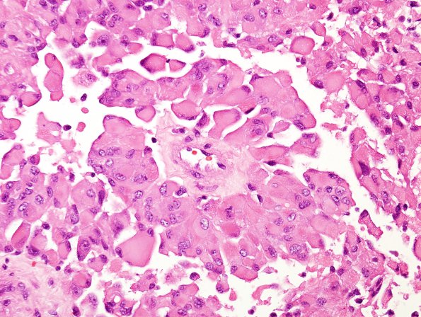 6A7 Astroblastoma, malig (Case 6) H&E 5