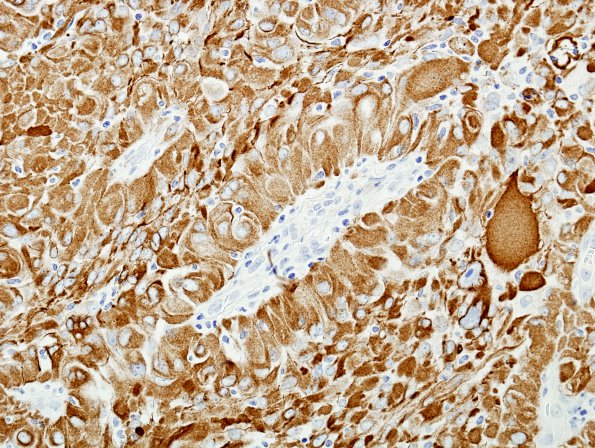 6B1 Astroblastoma, malig (Case 6) GFAP 1