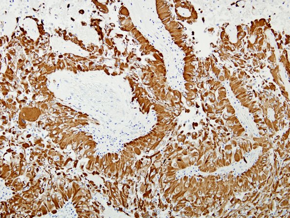 6B2 Astroblastoma, malig (Case 6) GFAP 2