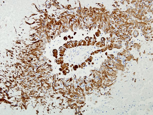 6B3 Astroblastoma, malig (Case 6) GFAP 3