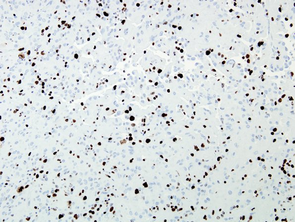 6C Astroblastoma, malig (Case 6) MIB 1