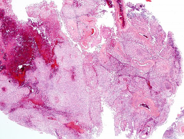 7A1 Astroblastoma, anaplastic (Case 7) H&E 3.jpg