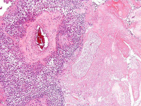 7A2 Astroblastoma, anaplastic (Case 7) H&E 2.jpg