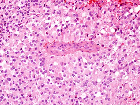 7A3 Astroblastoma, anaplastic (Case 7) H&E 9.jpg