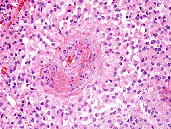 7A4 Astroblastoma, anaplastic (Case 7) H&E 8.jpg