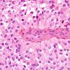 7A5 Astroblastoma, anaplastic (Case 7) H&E 10.jpg