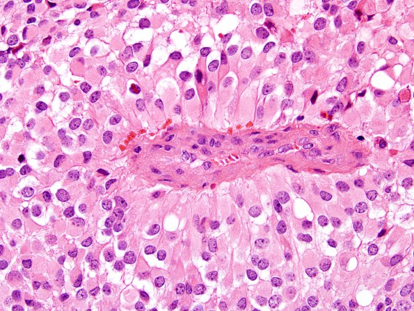 7A5 Astroblastoma, anaplastic (Case 7) H&E 10.jpg