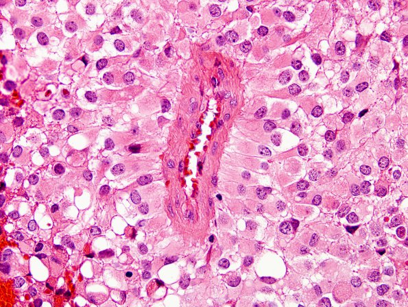 7A6 Astroblastoma, anaplastic (Case 7) H&E 13.jpg