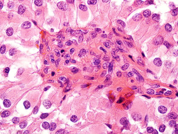 7A7 Astroblastoma, anaplastic (Case 7) H&E 100X 10.jpg