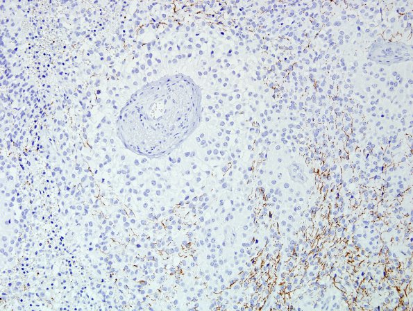 7B Astroblastoma, anaplastic (Case 7) NF 2.jpg