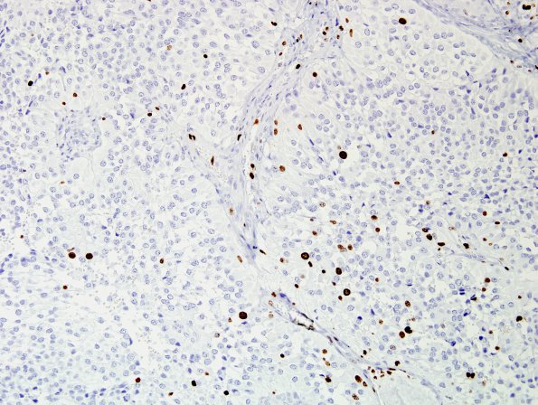 7C Astroblastoma, anaplastic (Case 7) Ki67 2.jpg