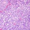 8A1 Astroblastoma, anaplastic vs GBM (Case 8) H&E 4.jpg