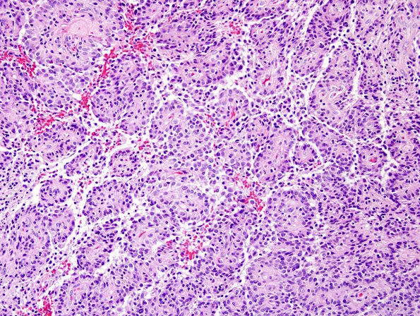 8A1 Astroblastoma, anaplastic vs GBM (Case 8) H&E 4.jpg