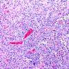 8A2 Astroblastoma, anaplastic vs GBM (Case 8) H&E 2