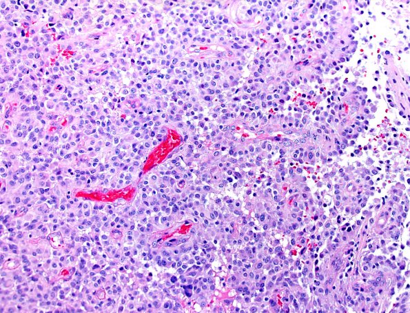 8A2 Astroblastoma, anaplastic vs GBM (Case 8) H&E 2