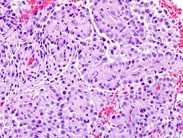 8A3 Astroblastoma, anaplastic vs GBM (Case 8) H&E 2.jpg