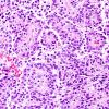 8A4 Astroblastoma, anaplastic vs GBM (Case 8) H&E 5.jpg