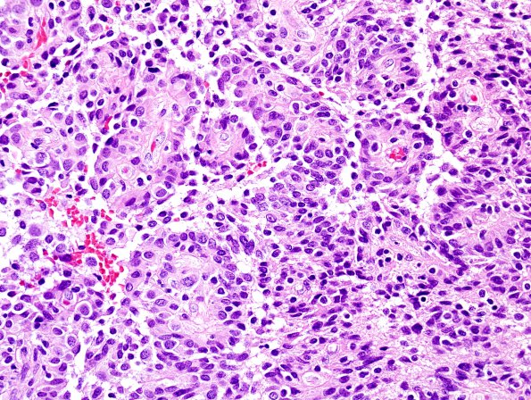 8A4 Astroblastoma, anaplastic vs GBM (Case 8) H&E 5.jpg